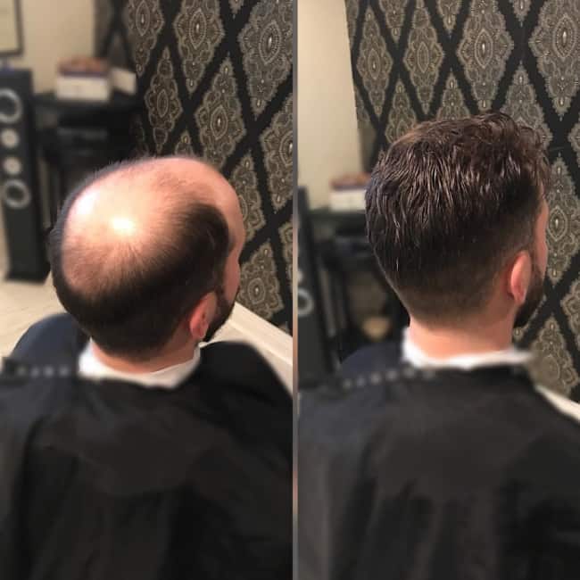Hair Replacement for Men Rochester NY