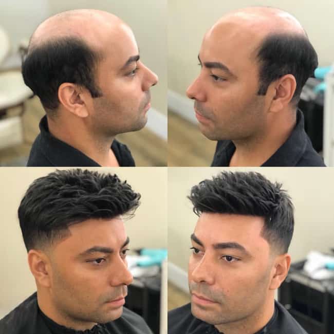 Non-Surgical Hair Replacement